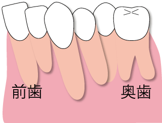 アゴが小さく、歯が収まらない場合