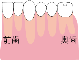 アゴが小さく、歯が収まらない場合