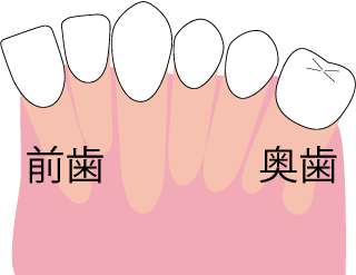 無理やり歯を並べる