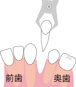 歯を抜いてスペースを作る