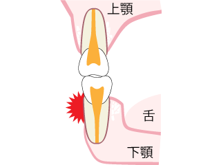 歯根露出