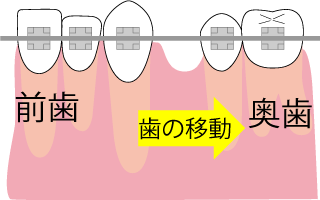 水平方向（横への）歯の移動