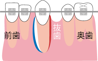水平方向（横への）歯の移動