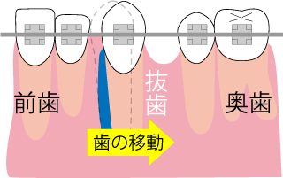 水平方向（横への）歯の移動