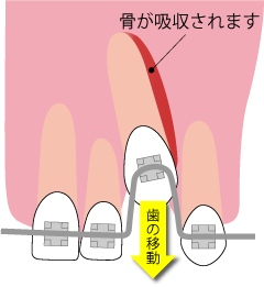 上下の歯の移動